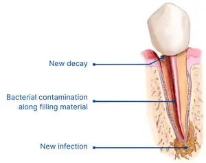 Root Canal Retreatment Diagram