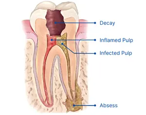 Root Canal Therapy Diagram